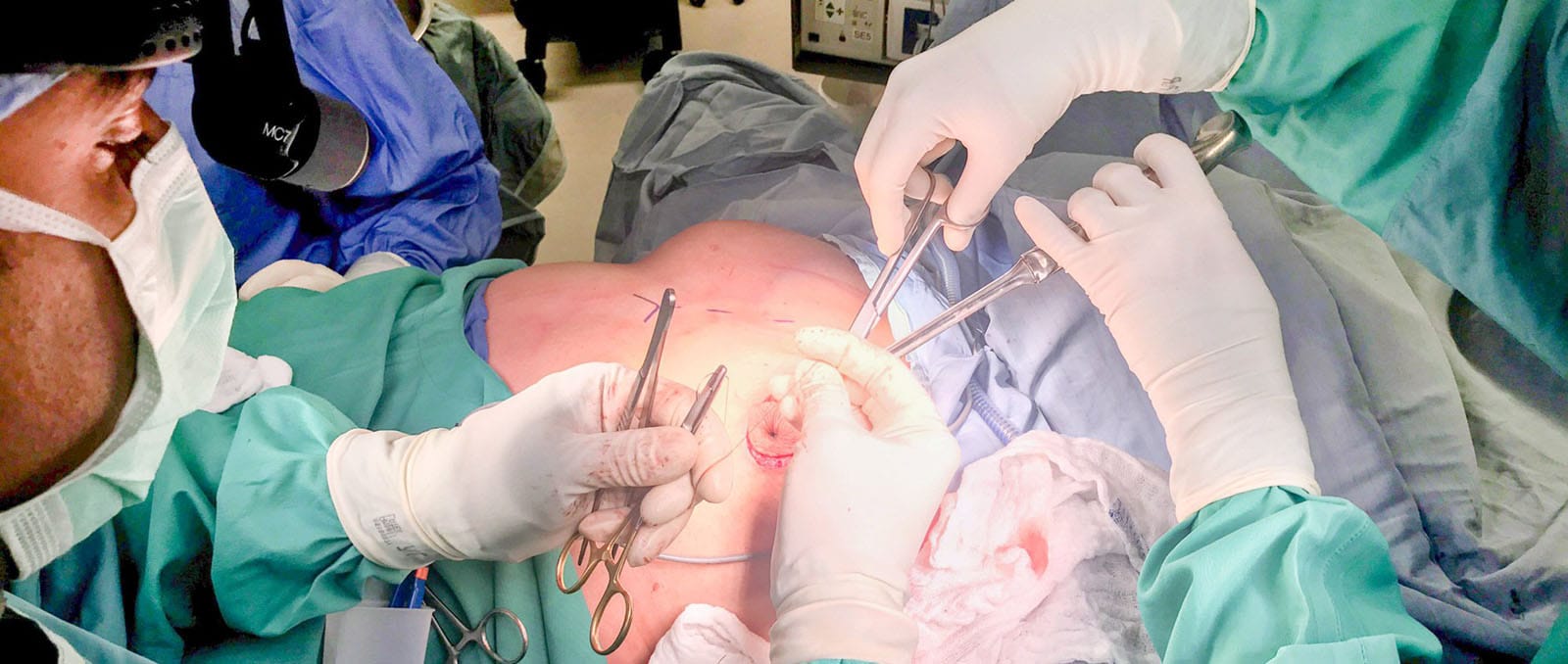 Ästhetische und medizinische Vorteile einer Brustverkleinerung
